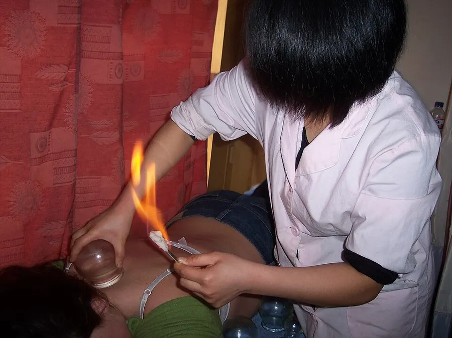 Cupping Therapy — traditional medicine tradition