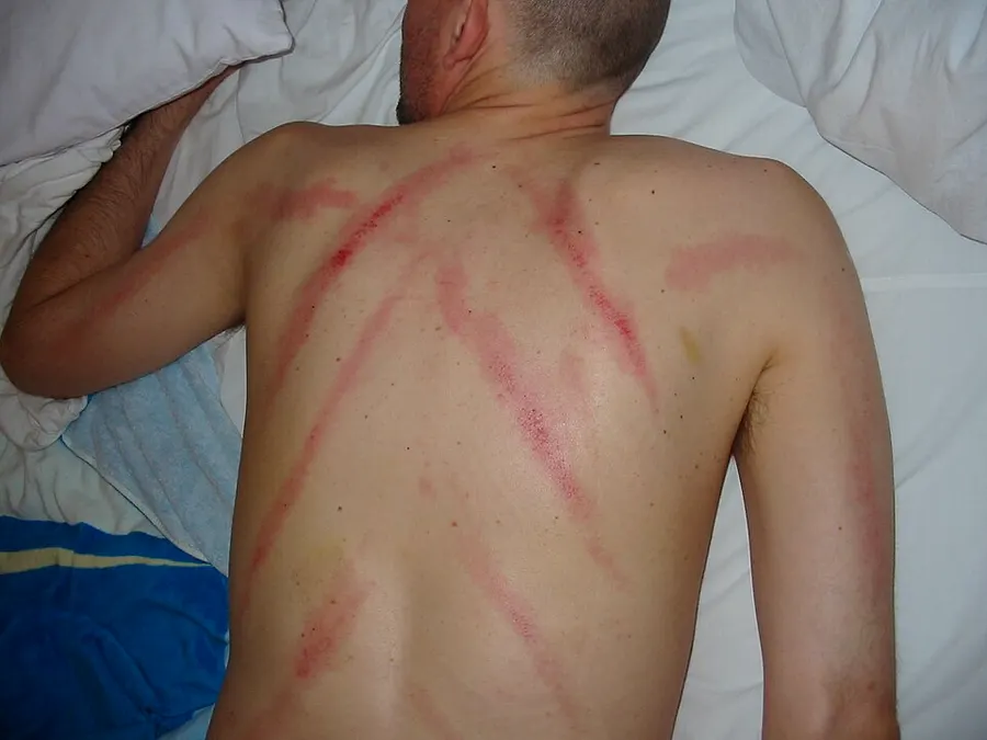 Guasha Scraping Therapy — traditional medicine tradition